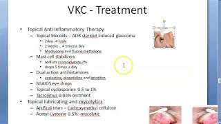 Ophthalmology 088 c Vernal KeratoConjunctivitis Spring Catarrh Treatment How [upl. by Yreneh]