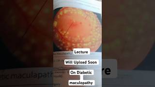 Diabetic maculopathy  Lecture Will Uploaded Soon diabeticretinopathy [upl. by Fredkin586]