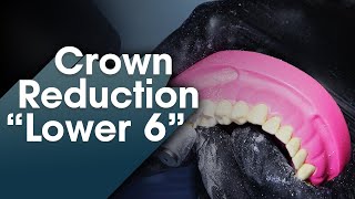 Full Metal Crown Preparation Lower 6 [upl. by Gail572]