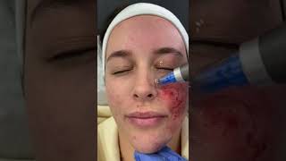 Microneedling with Dermapen 4 at DRMEDISPA [upl. by Rehpotsirc84]