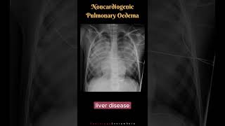 Noncardiogenic Pulmonary Edema Differential Diagnosis shorts radiologyshorts [upl. by Ressan]