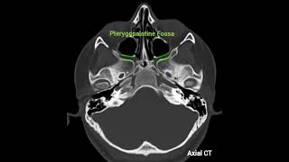 6🌺 An anatomical reminder🌺Foramen Rotundum and Pterygopalatine Fossa🎯Axial and coronal CT anatomy [upl. by Haswell]