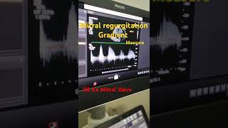 Mitral Regurgitation measure echocardiography treanding shorts [upl. by Barraza659]