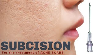 Subcision for Acne Scars  Advanced Dermatology amp Laser Institute of Seattle [upl. by Gahan]