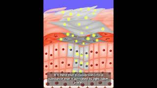 MultiLite Photodynamische Therapie PDT gegen aktinische Keratose [upl. by Norehc]