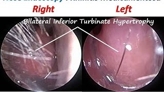 Nose Endoscopy  Rhinitis Medicamentosa Drug Induced RhinitisTopical Nasal Decongestants [upl. by Gerrald]