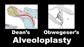 Deans Alveoloplasty amp Obwegeser Alveoloplasty [upl. by Trimmer630]