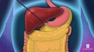 🤔 ¿Cómo se realiza la cirugía de Manga Gástrica Explicación 3D  Dra Pompa  LIMARP BARIATRIC [upl. by Aicemak]