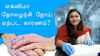 Hand Eczema  எக்ஸிமா தோலழற்சி நோய் ஏற்பட காரணம்DrGayathrirajesh  Tamil [upl. by Jehanna638]