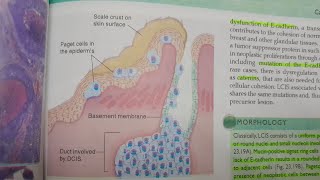 Preinvasive and Invasive Ductal and Lobular Breast Carcinoma Part 2  SPECIAL PATHOLOGY [upl. by Alanah]