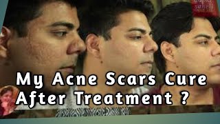 क्या Acne Scar Treatment करवाने से पिम्पल्स के गड्डे भर जाते है Conclusion of my AcneScar Treatment [upl. by Chancellor]