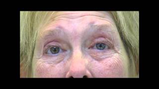 VIMPAT Blepharospasm Hemifacial Spasm Testimonial 2 [upl. by Aynotel]