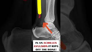 What is an ACHILLES TENDON Avulsion [upl. by Asilem328]