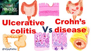 Ulcerative colitis Vs Crohns disease inflammatoryboweldisease [upl. by Blanch]