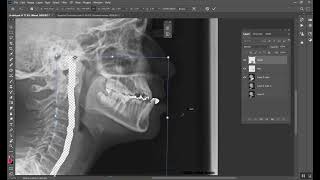 Treatment of Class III malocclusion المرحلة الخامسة [upl. by Ainwat]