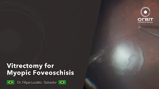 Orbit tips 046  Vitrectomy for Myopic Foveoschisis [upl. by Rasaec]