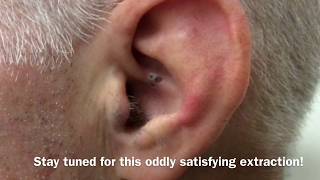 Ear Blackhead Extraction  Dr Steven Greene in Seattle [upl. by Inilam769]