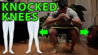 Treat Knock Knees with Easy Stretches amp Exercises [upl. by Ahcsim285]