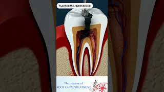 Normal Filling vs Root Canal Treatment What’s the Difference 🦷 [upl. by Sirromaj]