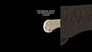 ACL Reconstruction The Importance of Femoral Tunnel Placement aclrepair orthopaedics ortho [upl. by Arikaahs153]