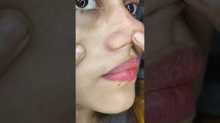 easy way to remove blackheads amp whiteheads at home remedy shorts youtubeshorts skincare beauty [upl. by De490]