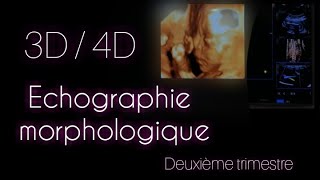 Cas clinique  Echographie Obstétricale morphologique du deuxième trimestre 3D  4D  GH [upl. by Knowlton335]