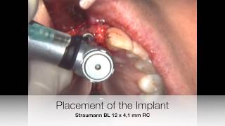 Implant placement in the incisive canal [upl. by Fitting]