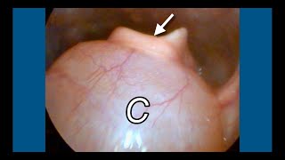 A Huge Epiglottic Cyst Causing Lump Sensation In The Throat [upl. by Kikelia]