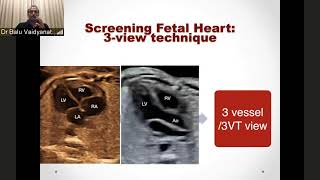 GE Webinar An approach to diagnosis of common congenital heart defects in fetus using 2D imaging [upl. by Morel]