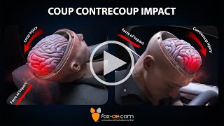 Coup  Contrecoup Impact [upl. by Yvette161]