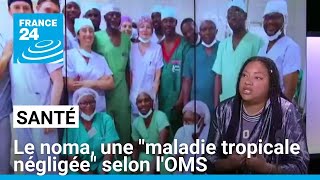 Le noma une quotmaladie tropicale négligéequot selon lOMS • FRANCE 24 [upl. by Oos]