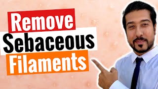 Sebaceous Filaments  3 Steps to Get Rid of Sebaceous Filaments FAST [upl. by Martie]