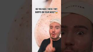 HOW TO GET RID OF TINY BUMPS ON YOUR NOSE😱 follow for more💗 beauty skincare skin acne [upl. by Lajib]