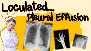 CHEST Xray  Loculated Pleural Effusion [upl. by Emil131]