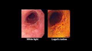 Barrets Esophagus  Clinical Features [upl. by Nitniuq512]