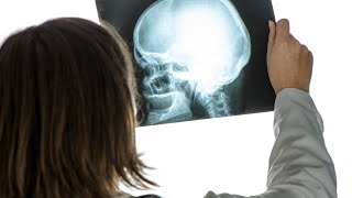 Le traumatisme craniocérébral une blessure sournoise [upl. by Nolasba]