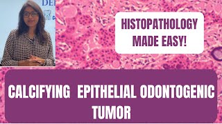 CALCIFYING EPITHELIAL ODONTOGENIC TUMOR  PART2  HISTOPATHOLOGY MADE EASY I ORAL PATHOLOGY [upl. by Ahgem]