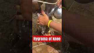 Hygroma Knee dr Umar khan [upl. by Heintz]