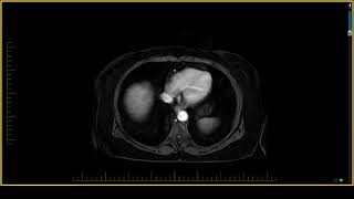 Pancreas Imaging  Obstructive Chronic Pancreatitis [upl. by Ardiedak979]