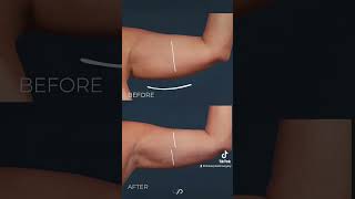 Before and After Video Arm Liposuction Transformation [upl. by Kred]