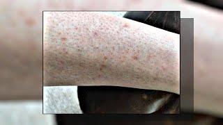 Seborrheic Keratosis What Is It amp How to Treat It [upl. by Rola394]