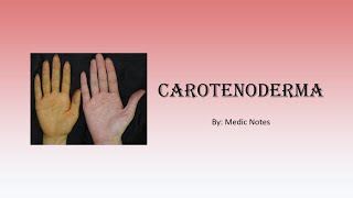 Carotenoderma  orange skin causes and pathophysiology [upl. by Zales]