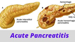 Acute pancreatitis [upl. by Garner]