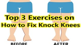 Top 3 Exercises on How to Fix Knock Knees [upl. by Ecnerwaled]