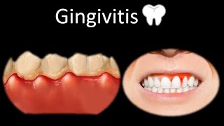 🦷 Gingivitis  Cavidad oral  Cabeza y Cuello  Patología [upl. by Alimaj]