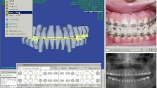 SureSmile Software Demo [upl. by Shantha402]