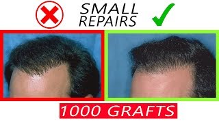 1000 graft Hair Transplant Repair Cases  Before and After [upl. by Altis]