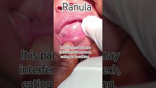 Lingual Bubble ranula oralpathology education salivarycyst health dentistryknowledge tongue [upl. by Nogras]