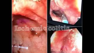 Ischemic colitis  colite ischemica [upl. by Craggy]