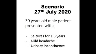 Oligodendroglioma 27th July 2020 [upl. by Ahsitel564]